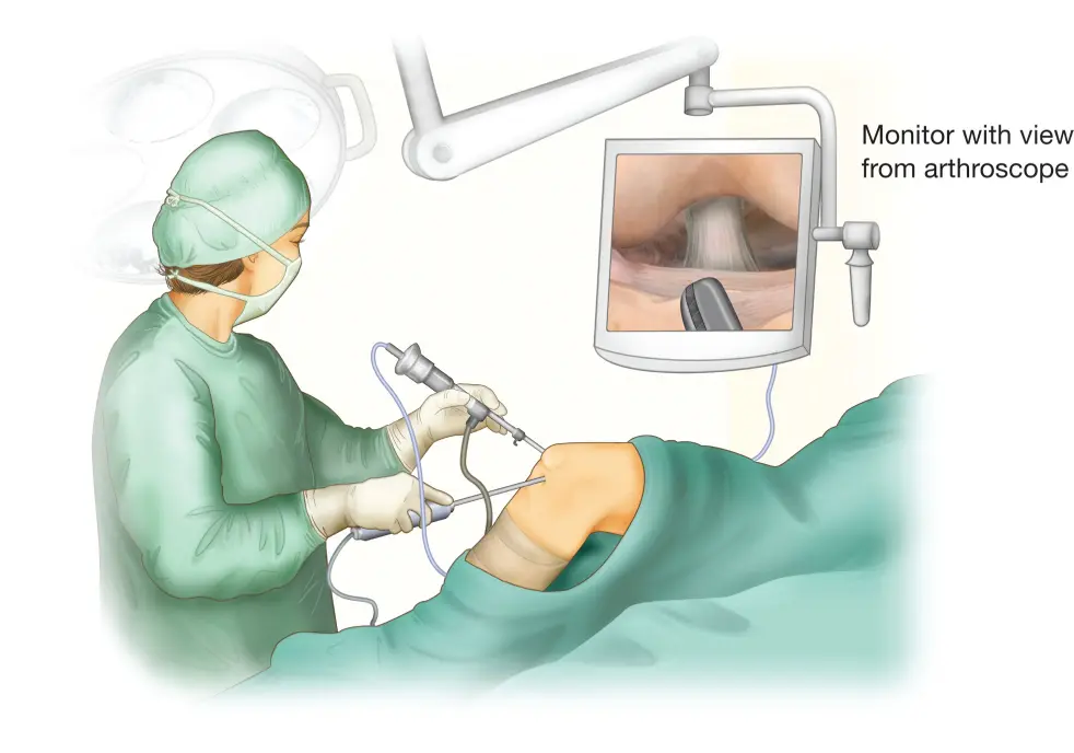 monitor arthroscopy