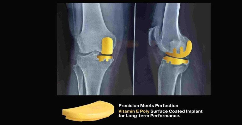 Knee Joint