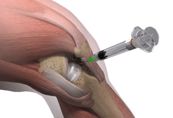 knee injection